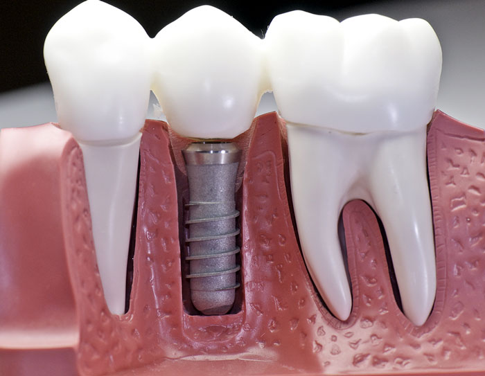 Dantų implantacija nebus baisi, jei įveiksite nežinomybę